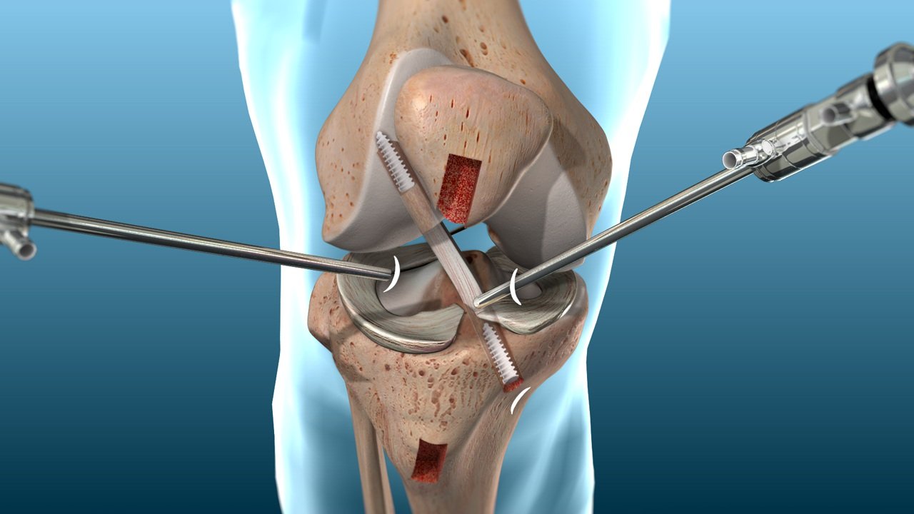 ACL Reconstruction Treatment