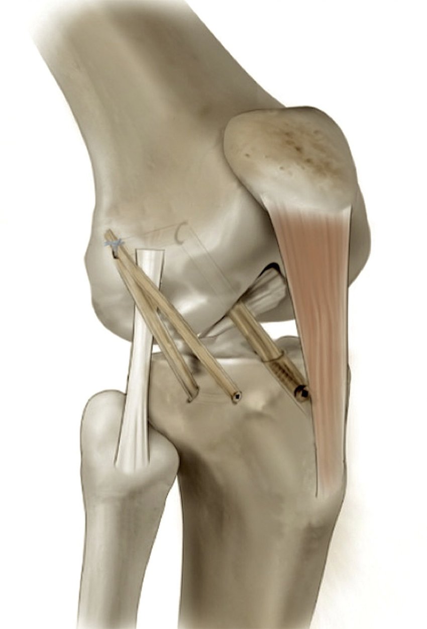 ACL Reconstruction Equipment