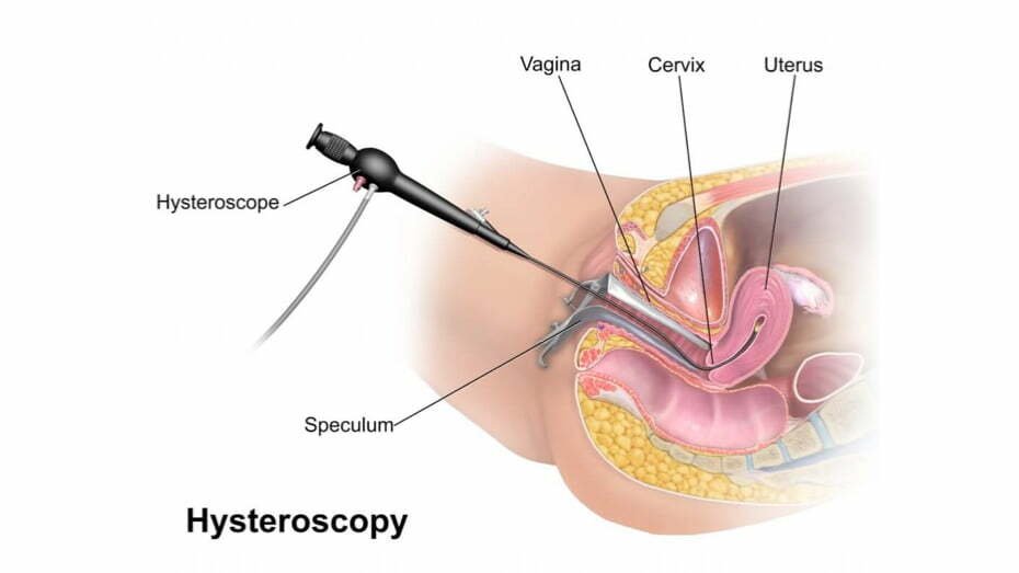 Hysteroscopic Tubal Cannulation