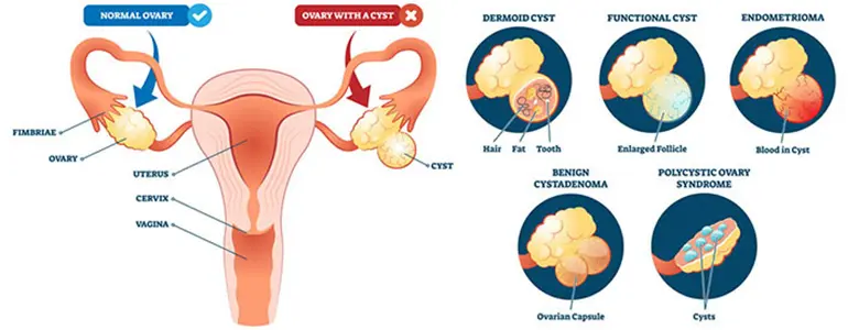 Ovarian Cystectomy