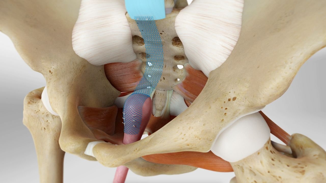 Sacrocolpopexy for Vault Prolapse