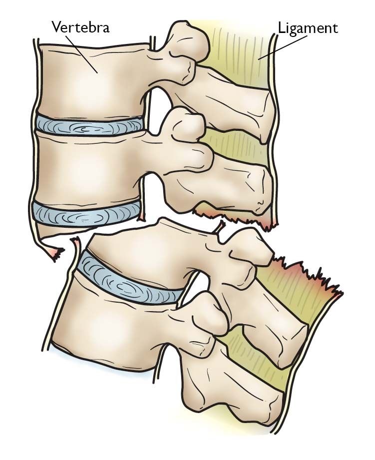 Spine Fracture Equipment