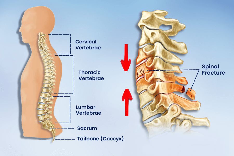 Spine Fracture Treatment