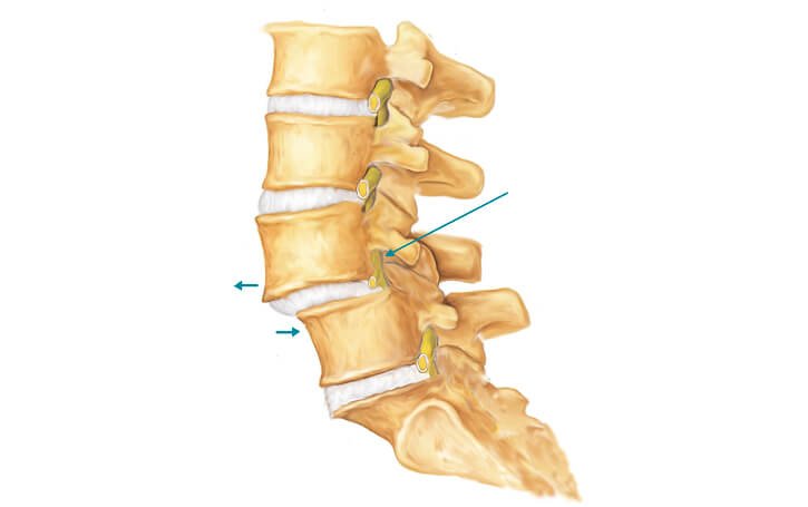 Spondylolisthesis Treatment