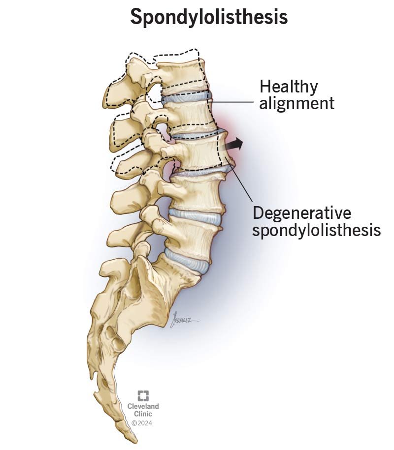 Spondylolisthesis Treatment Equipment