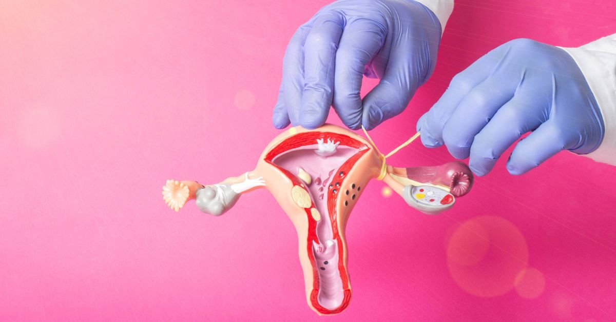 Tubectomy for Permanent Birth Control