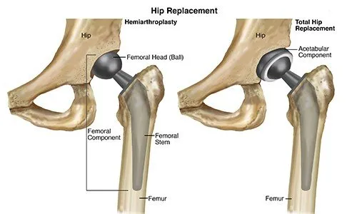 Hip Replacement Equipment