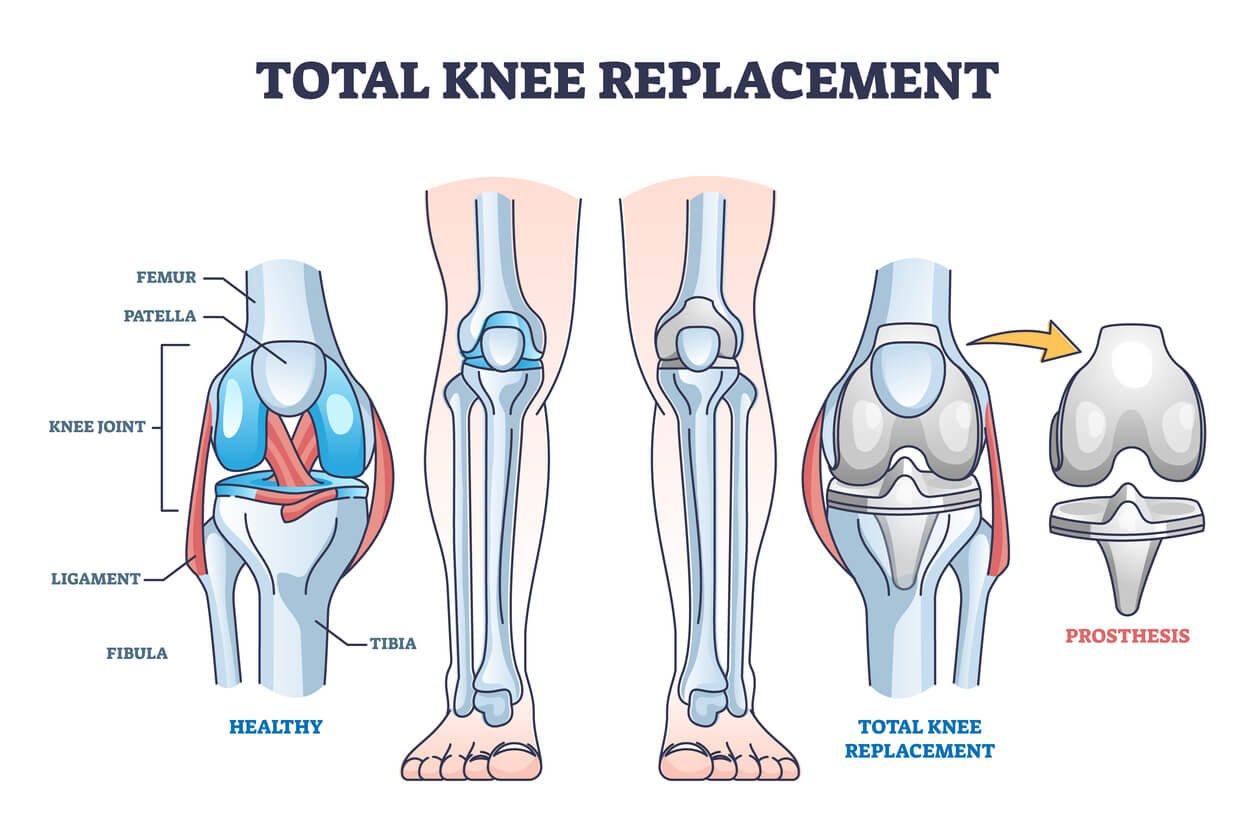 Knee Replacement