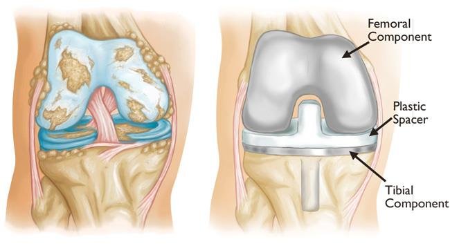 Knee Replacement Equipment