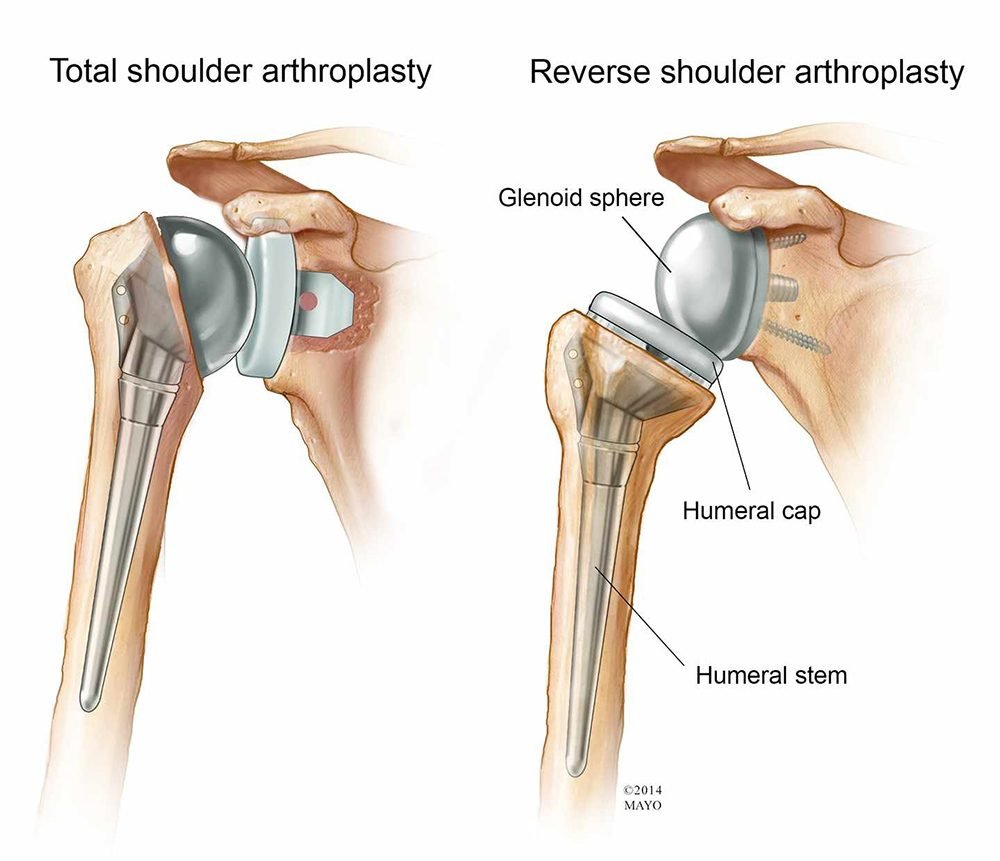 Shoulder Replacement Equipment